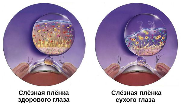 Изменение слёзной плёнки