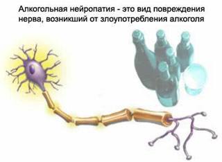 Алкогольная нейропатия