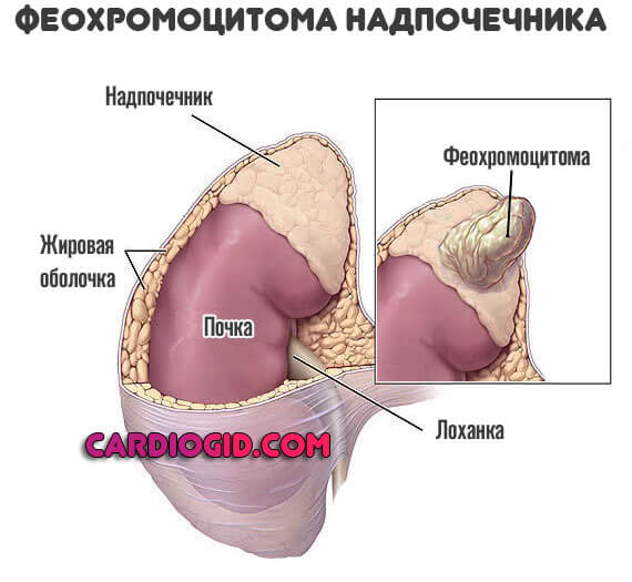 опухоль-надпочечника