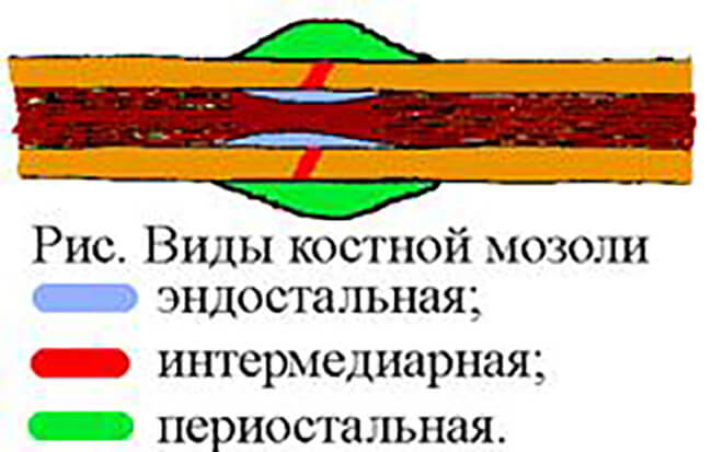 виды костной мозоли