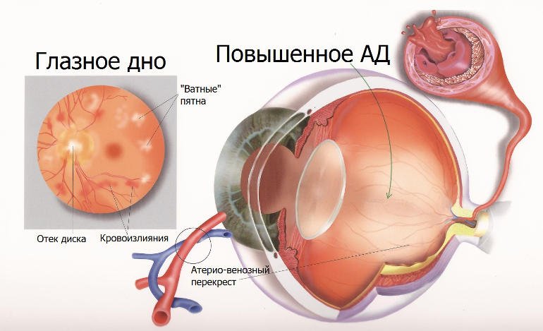 po-gipertonicheskomu-tipu