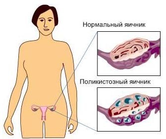 Поликистозный яичник