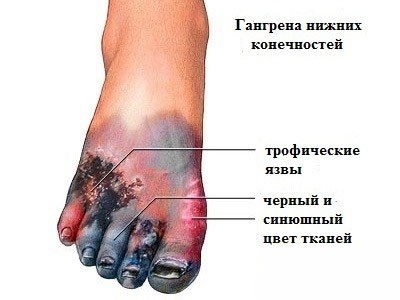 Признаки сухой гангрены ног