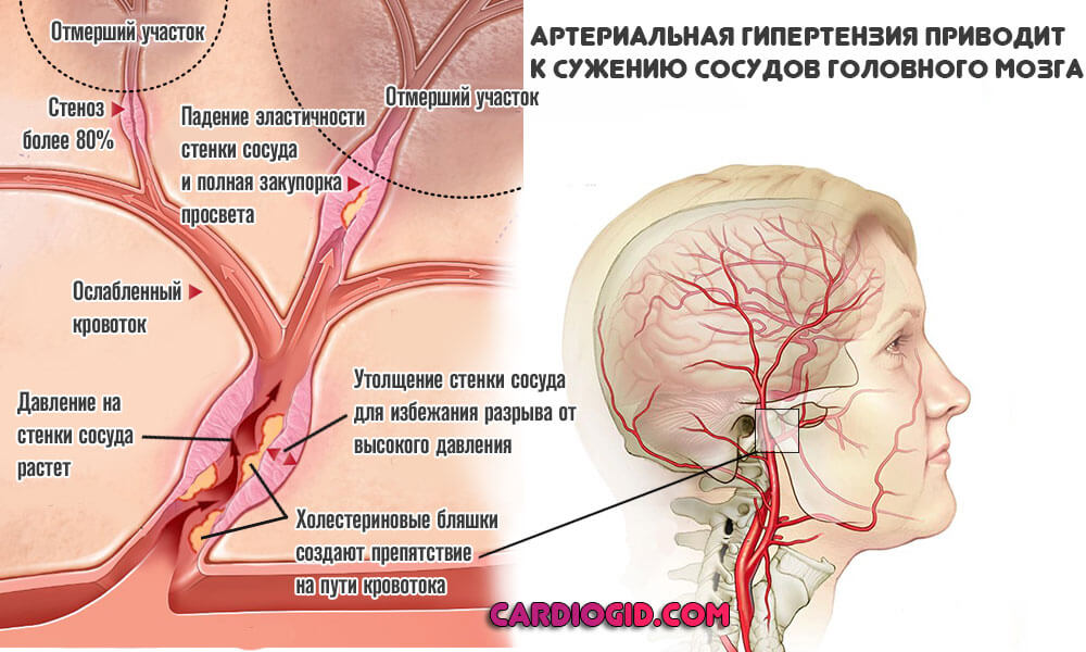 Сосудистая энцефалопатия с гипертензионным синдромом