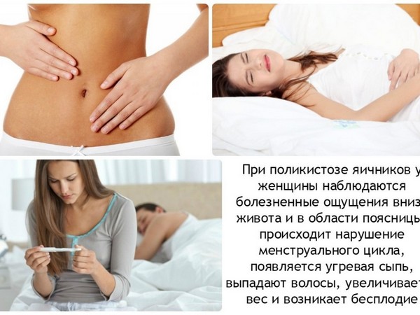 Симптомы поликистоза яичников