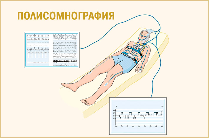 Проведение полисомнографии