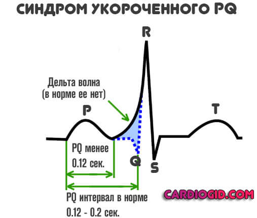 синдром укороченного pq