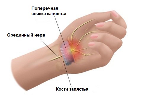 Туннельный синдром запястья