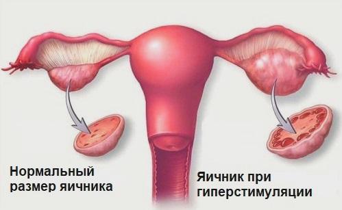 яичник при гиперстимуляции