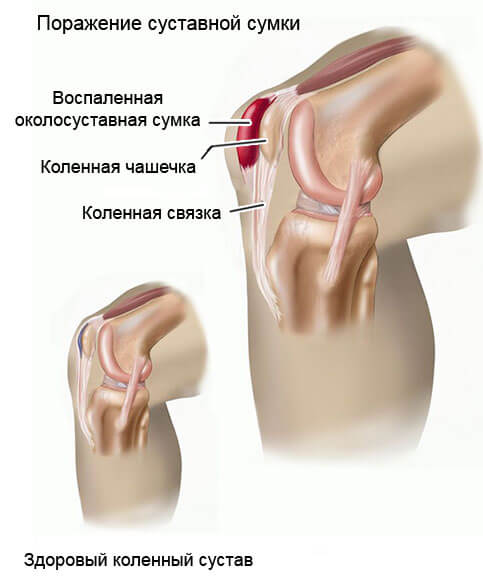 воспаление суставов